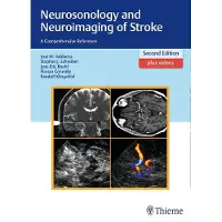 Neurosonology and Neuroimaging of Stroke: A Comprehensive Reference